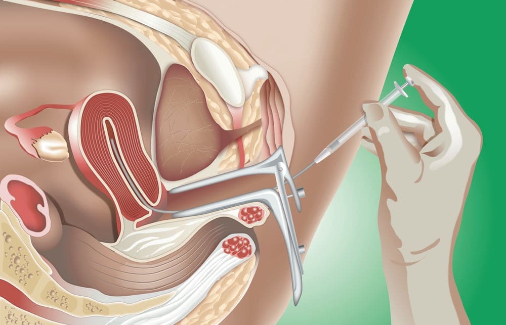 Intrauterine Insemination Specialist in Gujarat